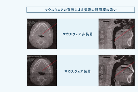 佐賀市の歯医者、池田歯科こども歯科でスポーツ用マウスピースの作製