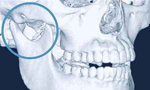 佐賀市の歯医者、池田歯科こども歯科で無痛治療