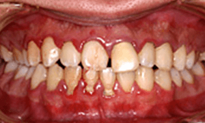 佐賀市の歯医者、池田歯科こども歯科で無痛治療