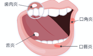 佐賀市の歯医者、池田歯科こども歯科で無痛治療