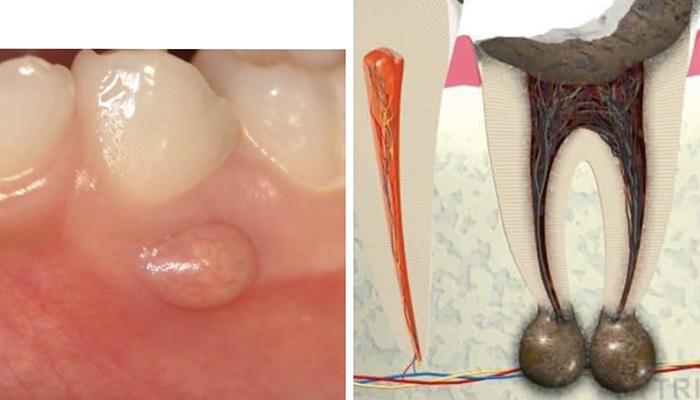 佐賀市の歯医者、池田歯科こども歯科でむし歯治療