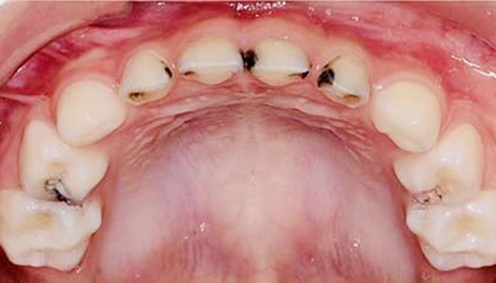 佐賀市の歯医者、池田歯科こども歯科でむし歯治療