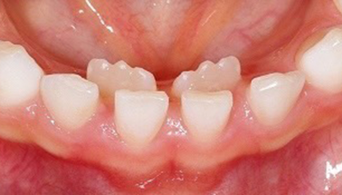 佐賀市の歯医者、池田歯科こども歯科でむし歯治療