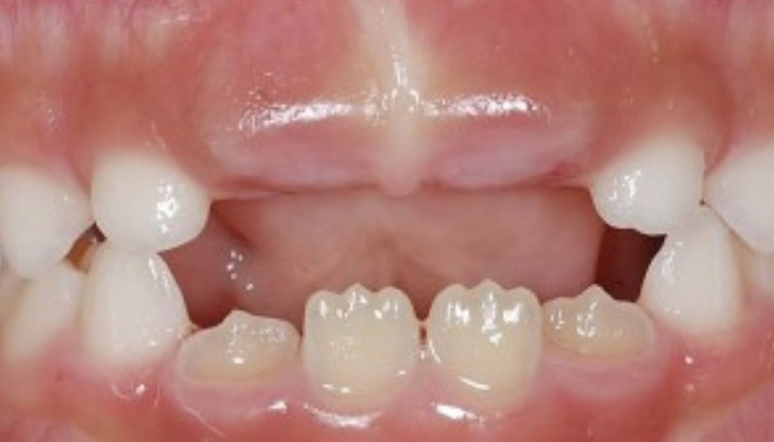 佐賀市の歯医者、池田歯科こども歯科でむし歯治療