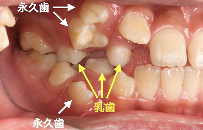 佐賀市の歯医者、池田歯科こども歯科でむし歯治療