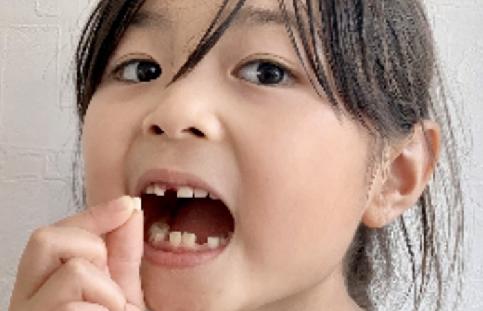 佐賀市の歯医者、池田歯科こども歯科でむし歯治療