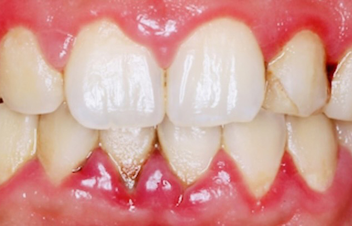 佐賀市の歯医者、池田歯科こども歯科でむし歯治療