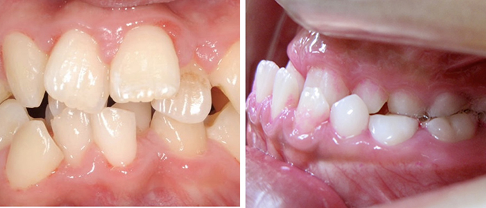 佐賀市の歯医者、池田歯科こども歯科でむし歯治療