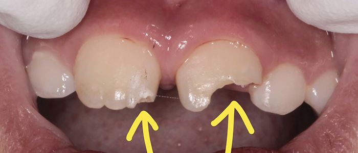 佐賀市の歯医者、池田歯科こども歯科でむし歯治療