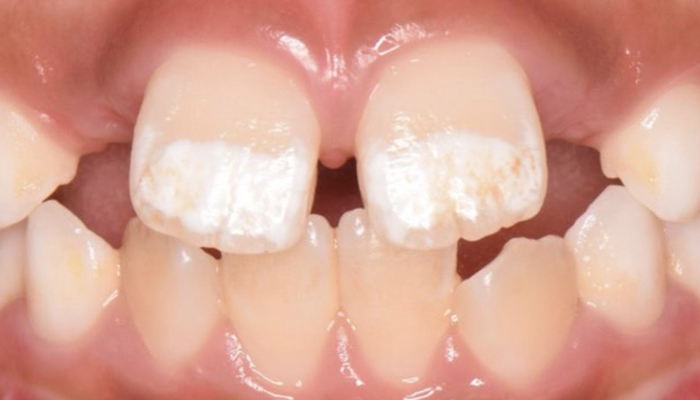 佐賀市の歯医者、池田歯科こども歯科でむし歯治療