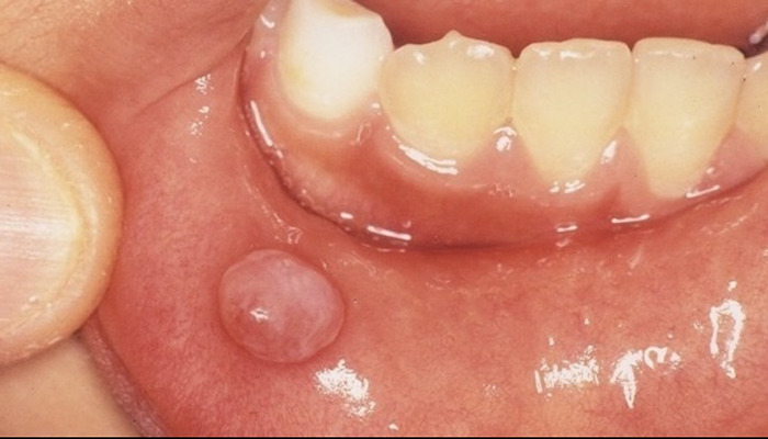 佐賀市の歯医者、池田歯科こども歯科でむし歯治療