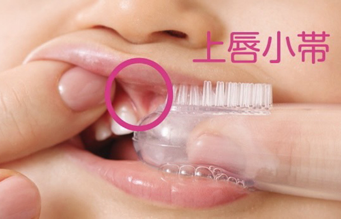 佐賀市の歯医者、池田歯科こども歯科でむし歯治療