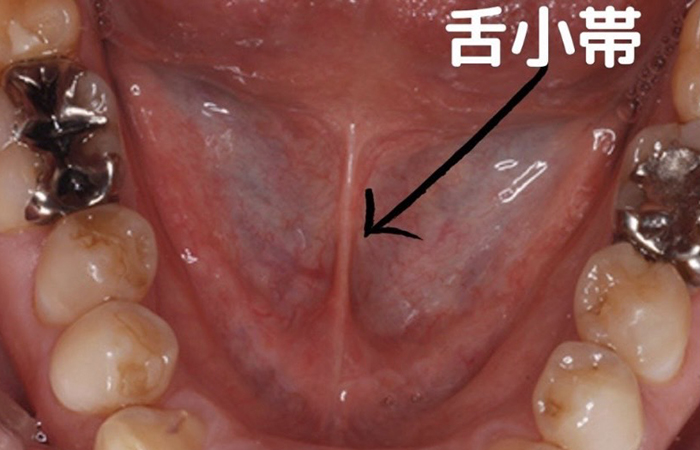 佐賀市の歯医者、池田歯科こども歯科でむし歯治療