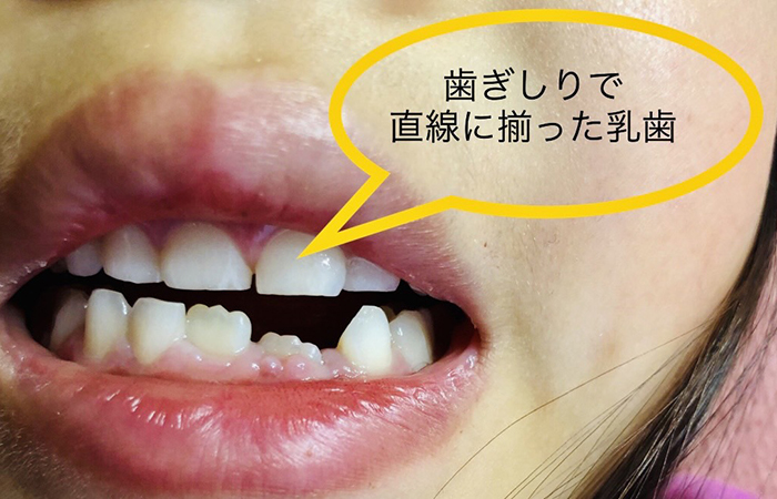 佐賀市の歯医者、池田歯科こども歯科でむし歯治療