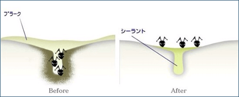 佐賀市の歯医者、池田歯科こども歯科で予防歯科