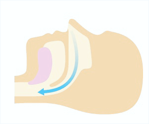 佐賀市の歯医者、池田歯科こども歯科で睡眠時無呼吸症候群の治療