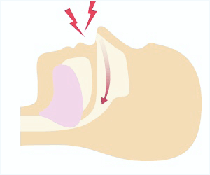 佐賀市の歯医者、池田歯科こども歯科で睡眠時無呼吸症候群の治療