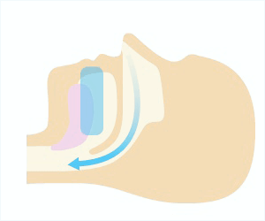 佐賀市の歯医者、池田歯科こども歯科で睡眠時無呼吸症候群の治療