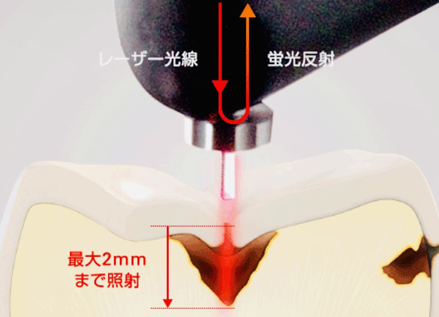 佐賀市の「池田歯科こども歯科」では可能な限り削らない
