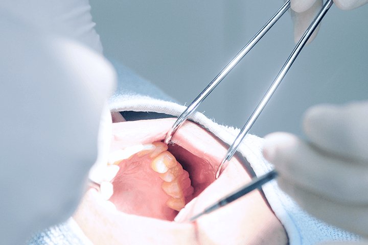 佐賀市の歯医者、池田歯科こども歯科で親知らずの抜歯