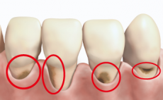 「歯の根」の表面にできるむし歯