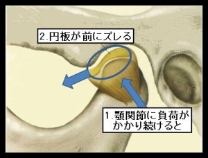 顎関節症の4つの分類